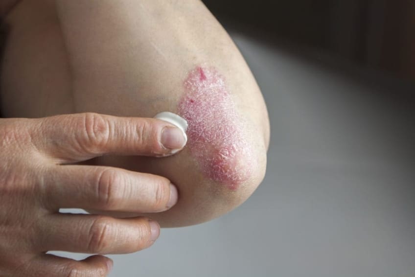 Woman applying lotion to psoriasis on her elbow
